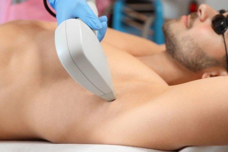 L'épilation au laser convient-elle aux hommes ?