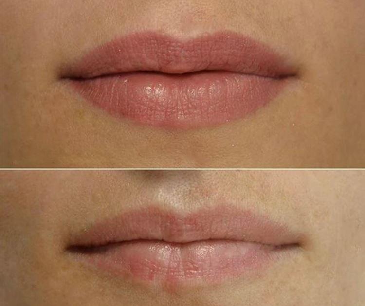 Maquillage permanent des lèvres - photos avant et après