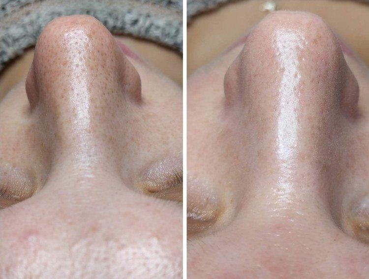 Nettoyage du visage par ultrasons - photos avant et après