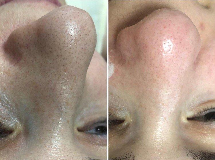 Nettoyage du visage par ultrasons - photos avant et après