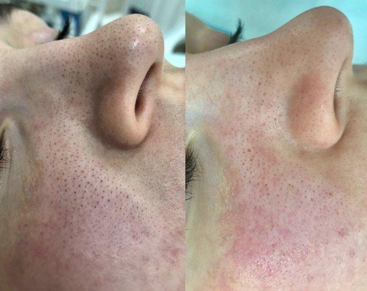 Nettoyage du visage par ultrasons - photos avant et après